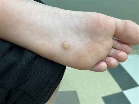 Cyst, wart, something else? : r/DermatologyQuestions