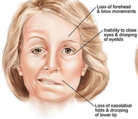 origin   word bells palsy  gregorypmillero blog