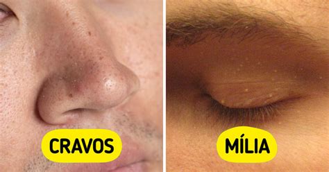 Bolinhas Que Parecem Espinhas - 7 Bolinhas na pele que enganam e parecem espinhas comuns