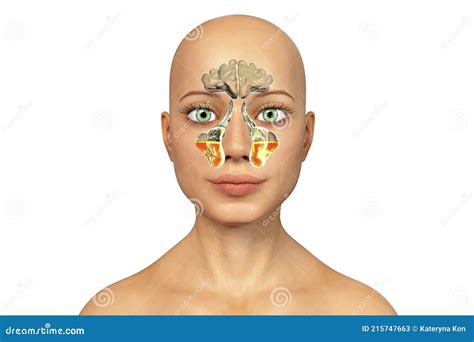 Purulent Inflammation of Maxillary Sinuses, Antrum of Highmore, in a ...