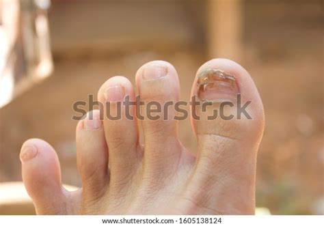 124 Blood Under Toenail Images, Stock Photos & Vectors | Shutterstock