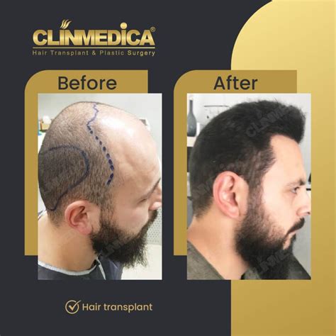 The Most Efficient 10 Clinics in Turkey to Choose for Your Hair ...