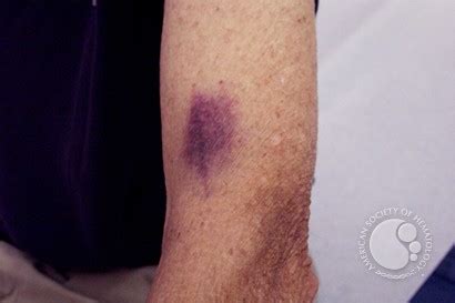 hematidrosis blood sweat