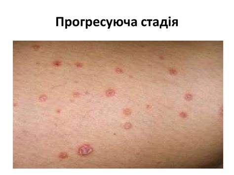 Папулосквамозні дерматози - online presentation