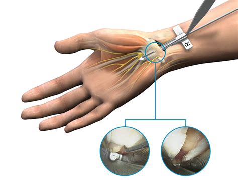 carpal tunnel syndrome surgery recovery time