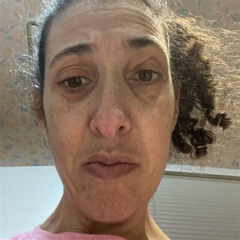 Woke up with red puffiness under my eyes . Burns when touched but only