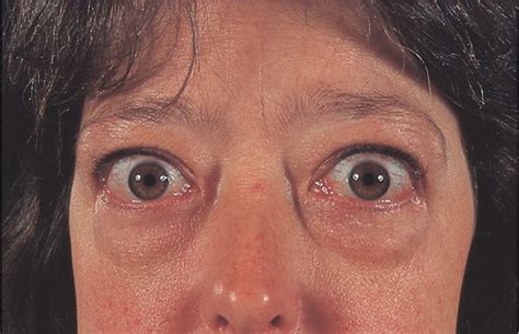 Graves' disease - The Lancet