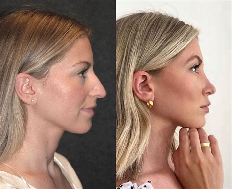 rhinoplasty    dr andrew jacono md facs nose