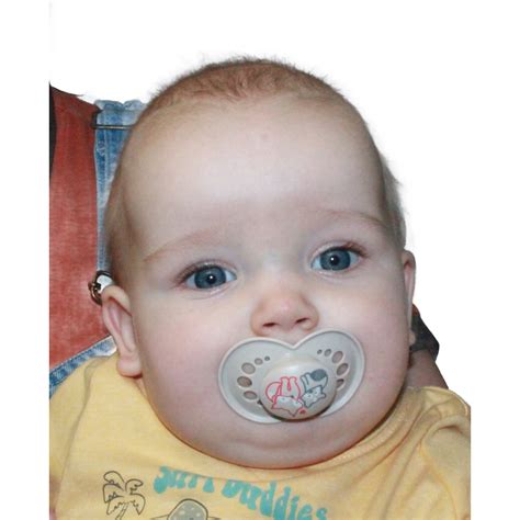 Sagittal Synostosis Repair - Kansas Cleft and Craniofacial Center