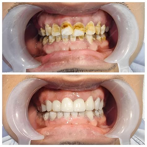 Before and after scaling and polishing treatment for tobacco staining