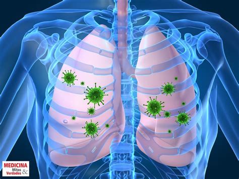 A Pneumonia É Contagiosa - Causas e sintomas da pneumonia | Medicina - Mitos e Verdades