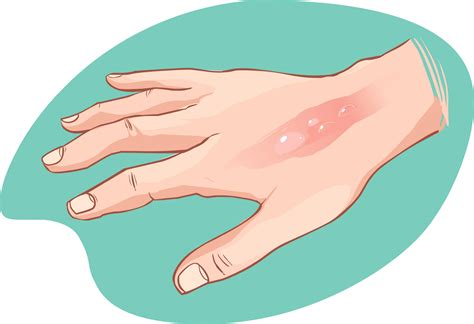 treat burn diagnosis  treatment