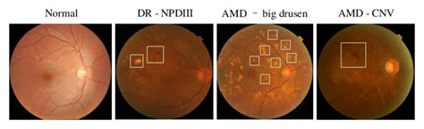 images  normal dr  amd  illustration npdriii big
