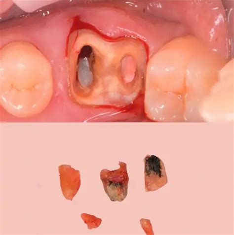 Tooth Extraction, Healing Implantation (part 2) 