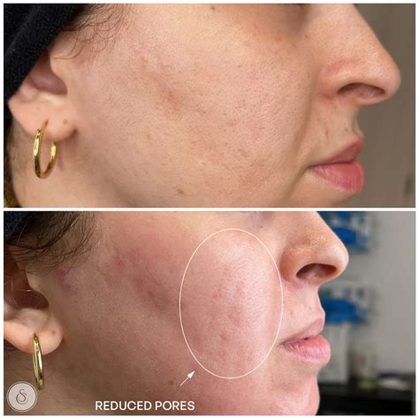 Aquashine: a radiantly healthy skin again | Sarasin Clinic