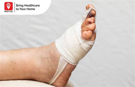 kaki bengkak bernanah   mempercepat penyembuhan