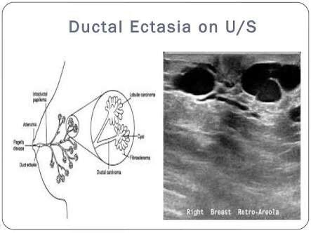 O Que É Ectasia Ductal - Ductal ectasia | Ultrasound sonography, Breast ultrasound, Diagnostic ...