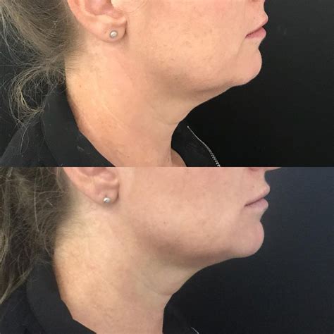 Non Surgical Face Lift For Jowls at Renee McConnell blog