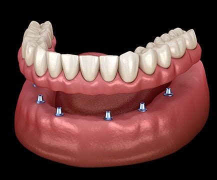 Implant Dentures Baltimore | Missing Teeth | Baltimore Dental Arts