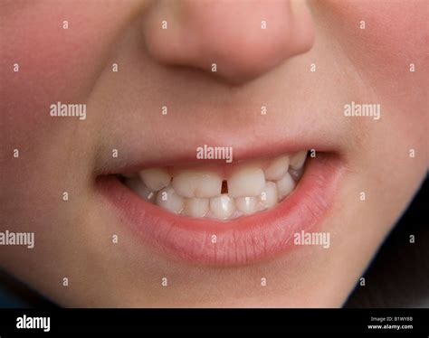 fused teeth  res stock photography  images alamy