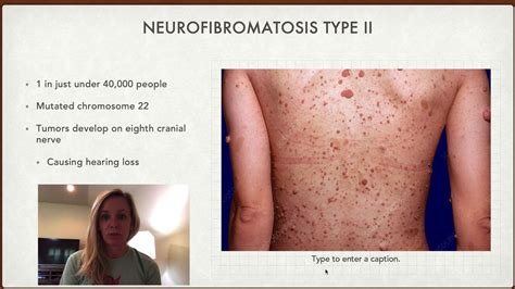 Neurofibromatosis Type 3