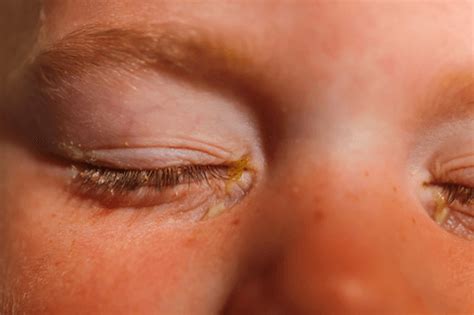 Conjunctivitis: Facts, causes, symptoms, types, treatment, & prevention ...