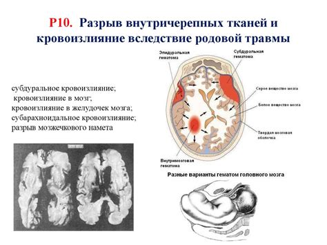 Родовые травмы новорожденных. Кефалогематома. Родовые травмы ЦНС ...