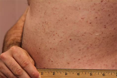 Leukemia Rash Pictures and Symptoms