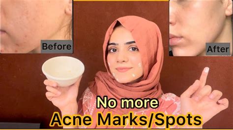 Remove Acne Marks 6 Easy Quick Ways To Remove Acne Ma - vrogue.co