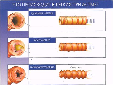 Бронхиальная астма и хобл: особенности диагностики и лечения ...