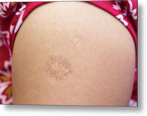 tetanus shot scar
