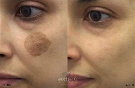 Birthmark - Este Medical Bangladesh Ltd : UK's Leading Skin, Body and ...