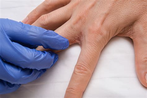 Dyshidrotic Eczema: PIctures, Symptoms and Causes