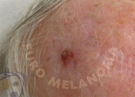 Spinocellulair of plaveiselcelcarcinoom - Euromelanoma