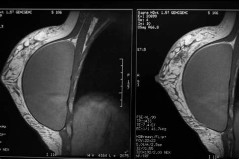 Breast Implants and Lymphoma - Breast Surgery & Breast Oncology