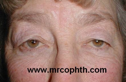 dermatochalasis