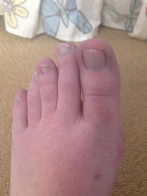 The many colors of Raynaud’s feet : r/Raynauds