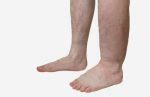 Weeping Edema: Causes, Symptoms, and Diabetes Link