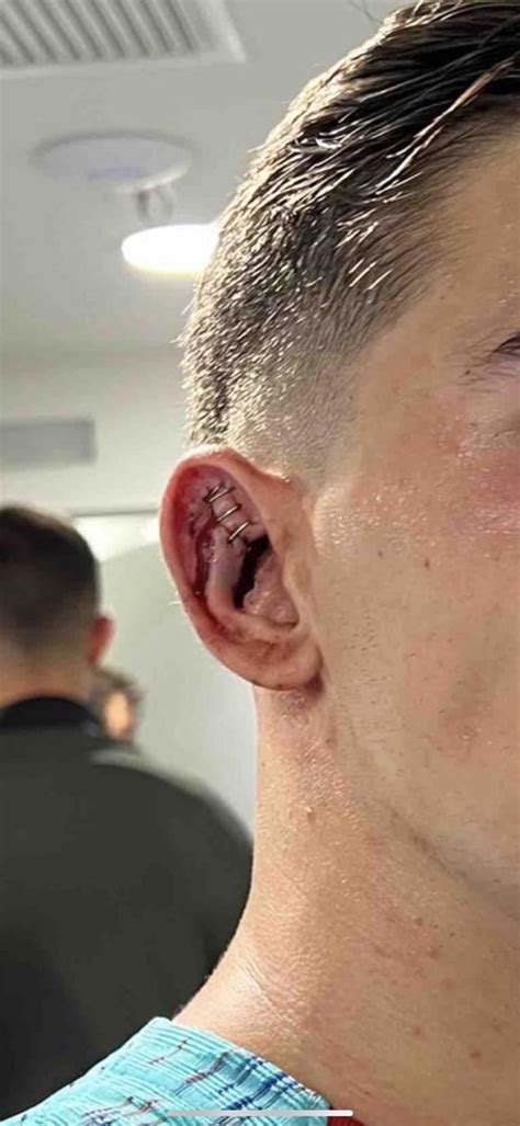 Gavi’s ear after the match : r/Barca