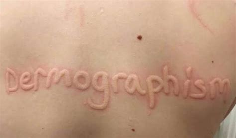 Dermatographism - MEDizzy