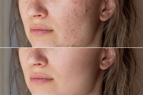 Acne Before And After