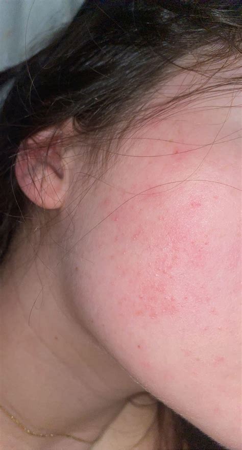 Fungal acne or eczema/irritation? Details in comments : r/Fungalacne