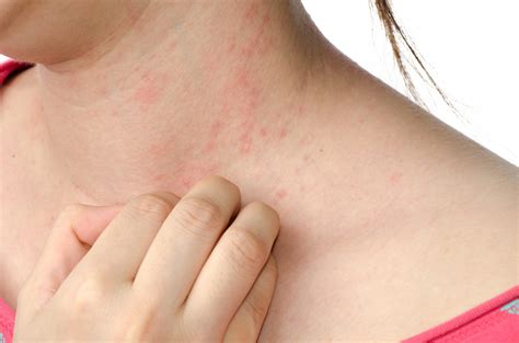 Eczema - Healthopedia UK