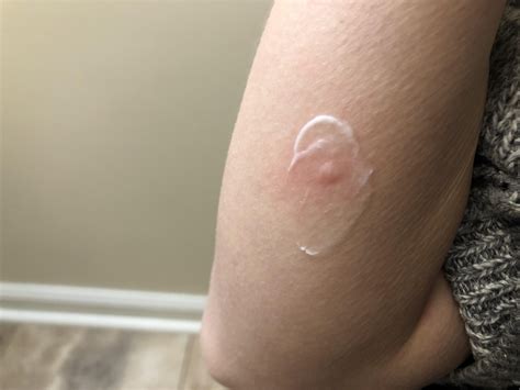 102 best r/histamineintolerance images on Pholder | Allergist visit