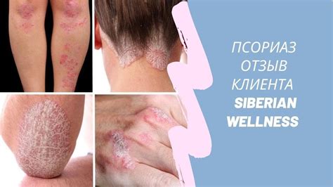 Псориаз. Отзыв клиента. Сибирское здоровье. Siberian Wellness. - YouTube