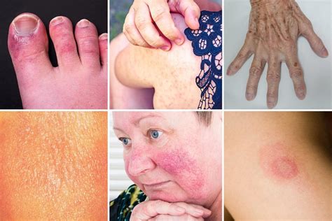 spot  deadly rash expert reveals