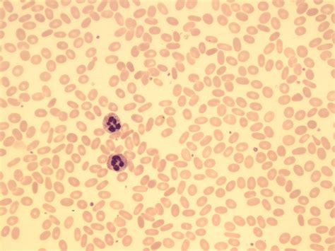 Elliptocytosis - 3 | ERA