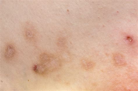 Dupixent Approved for Adults With Prurigo Nodularis