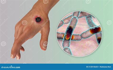 cutaneous anthrax   common form  anthrax stock illustration
