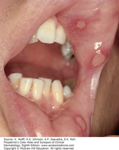 Disorders of the Mouth Flashcards | Quizlet